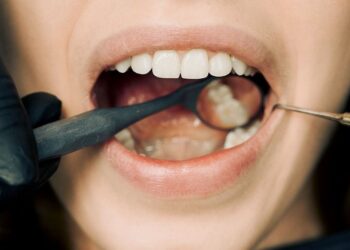 Pet naravnih načinov za odstranjevanje zobnega kamna brez obiska zobozdravnika