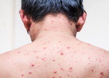 Mladenič iz Sarajeva umrl zaradi ošpic: Pozivi k cepljenju se stopnjujejo