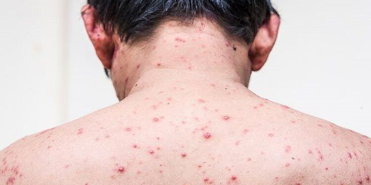 Mladenič iz Sarajeva umrl zaradi ošpic: Pozivi k cepljenju se stopnjujejo