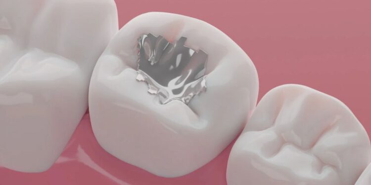 Od prihodnjega leta prepovedane amalgamske zalivke v EU