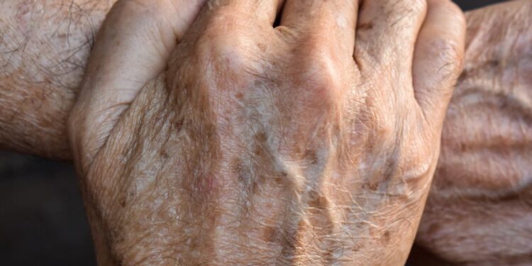 Naravni recept za odstranitev starostnih peg: Poslovite se od temnih madežev