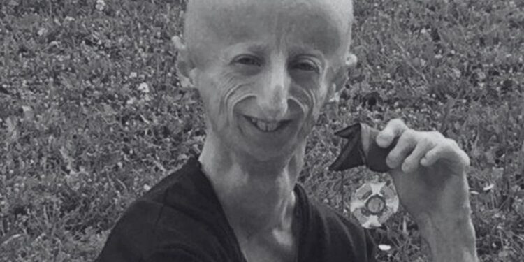 Sammy Basso – 28 let poguma in upanja za bolnike s progerijo