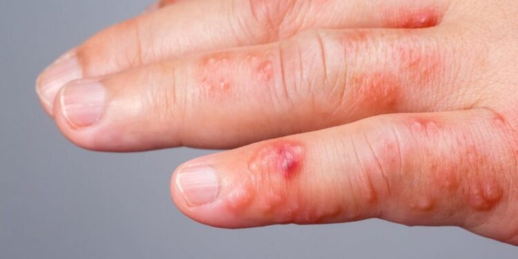 Število bolnikov z garjami narašča: Zdravniki opozarjajo na previdnost